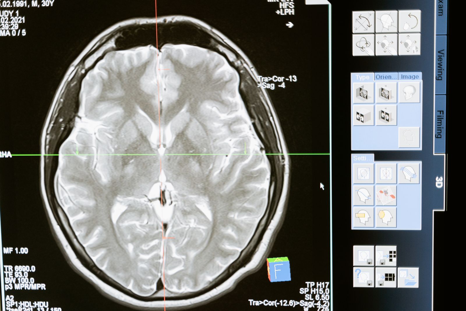 Brain MRI on a monitor