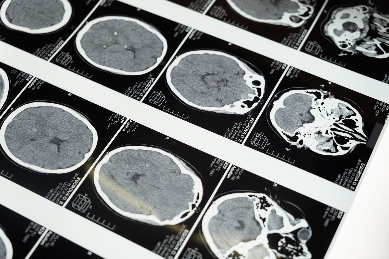 Brain scan films on a lightbox